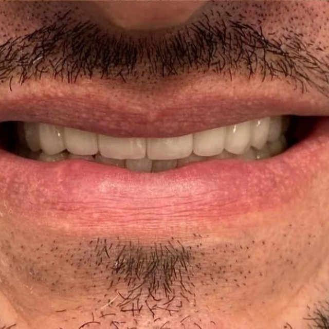 Smile after full reconstruction with a complete, even upper arch
