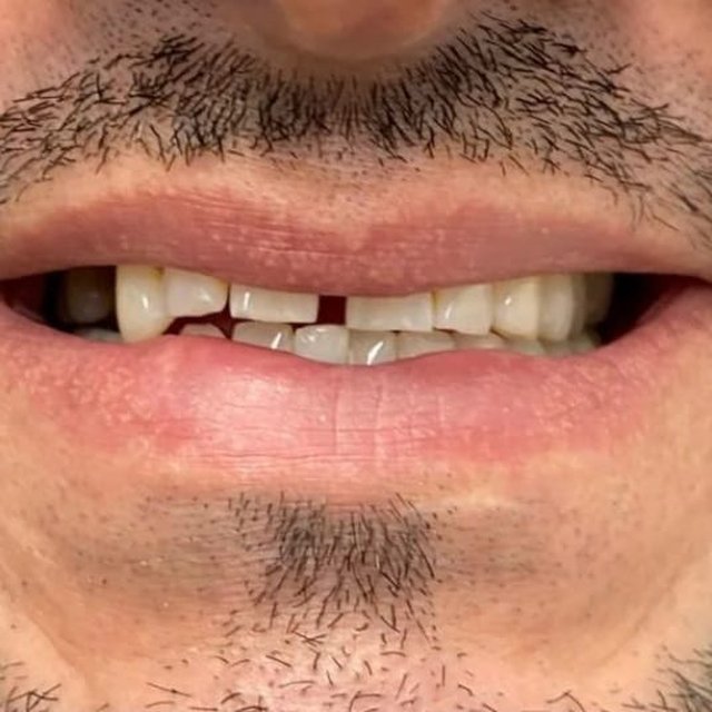 Smile before treatment with broken, worn upper front teeth