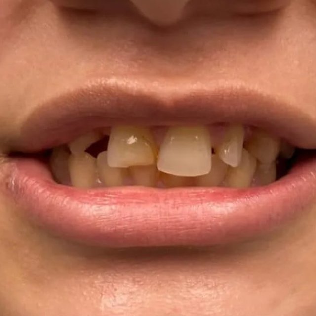 Smile before treatment with crowded, discolored upper teeth